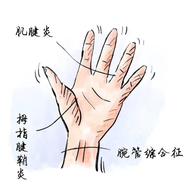 用小拇指当手机支架 手指会废吗 全网辟谣+权威研究