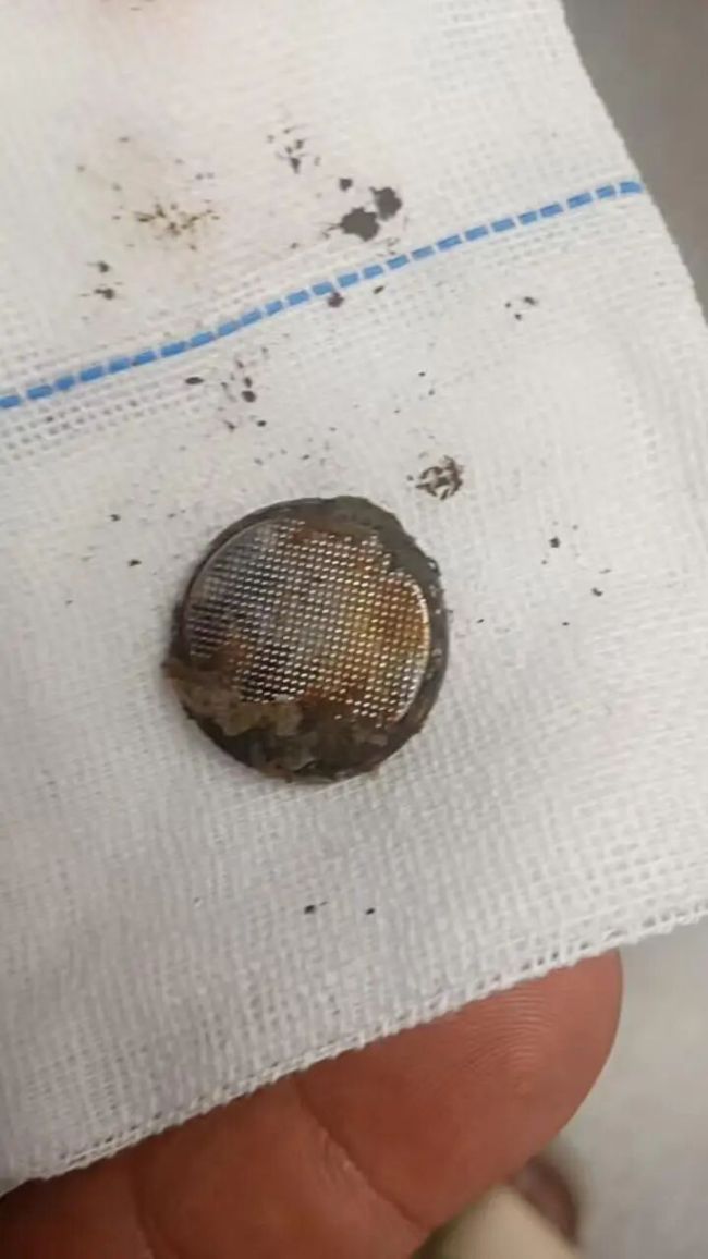女婴误吞电池26小时食道被腐蚀 警惕早期症状误导