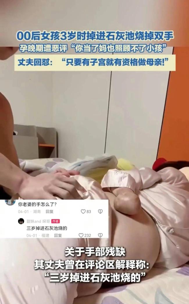 女子3岁烧掉双手现孕珠9个月遭质疑 丈夫回怼恶评