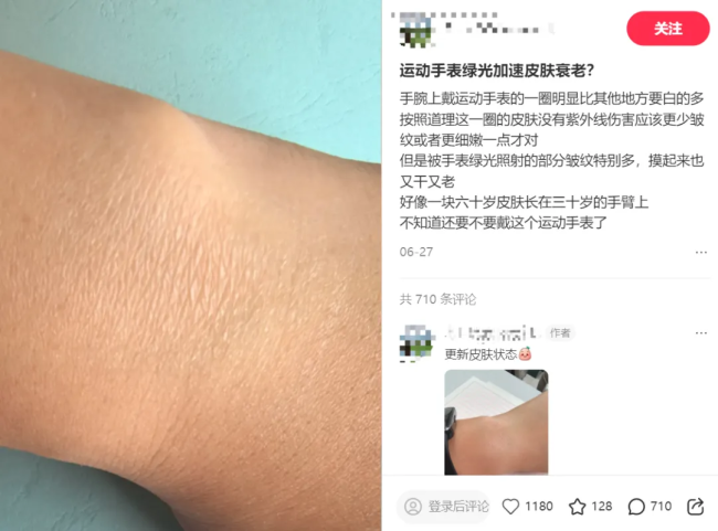 智能穿戴引发腕部皮肤 “老化”?皮肤科医生详解成因与佩戴建议