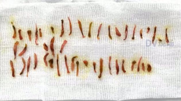 男子吃魚生致膽管被肝吸蟲堵住 未煮熟淡水魚蝦成罪魁禍首