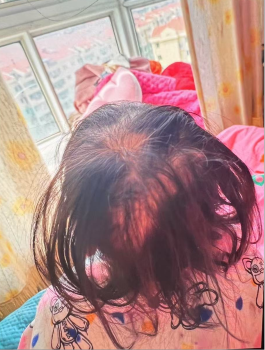 3歲女童突然脫發(fā) 查出鉈中毒 鉈中毒癥狀明顯