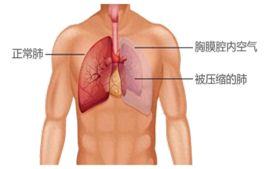 演员白宇因患气胸做过6次手术 分享经历呼吁关注