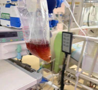 萌娃吃堅(jiān)果突變小黃人進(jìn)ICU 蠶豆病引發(fā)溶血危象