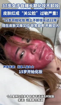 女子回应22年化妆不卸妆过敏：密密麻麻的小疹子，皮肤就像硬壳一样
