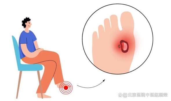 糖尿病足不只是“脚出了点小毛病” 三大元凶揭秘