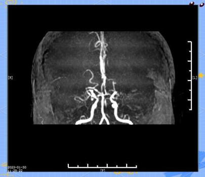 女子年年脑梗一查是罕见烟雾病 罕见病因需警惕