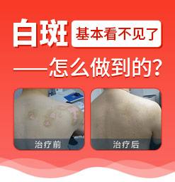 老年白癜风治疗哪家好选郑州西京 郑州西京医院患者反馈