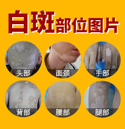 郑州治疗白癜风医院哪家好 如何才能做到早日好转