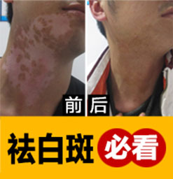 郑州西京专科医院怎么预防白癜风再次*