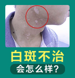 郑州西京白癜风医院的医生治疗白癜风专业吗