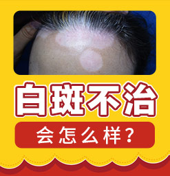 郑州西京白癜风医院治疗白斑怎么样