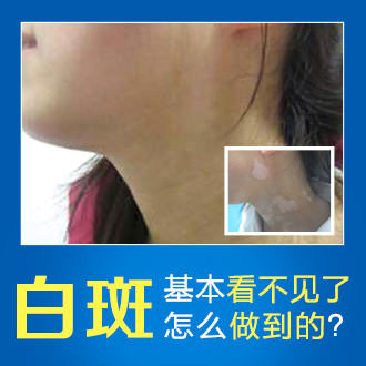 烟台专科医院治疗白癜风要多少钱 如何节省白斑治疗费用