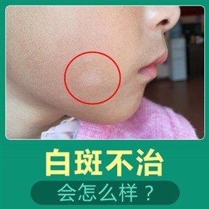 烟台白癜风病发后怎么治疗 烟台半岛哪个方法治疗好