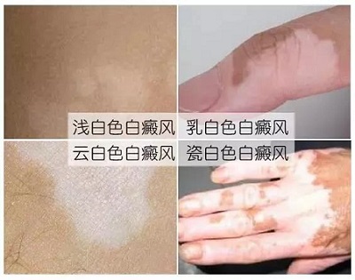 威海白斑专科医院如何*治疗白癜风