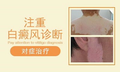 烟台白癜风皮肤病医院 怎么治疗手臂白斑