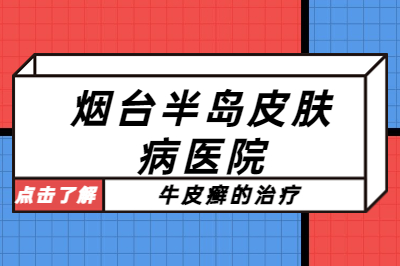 烟台的皮肤病医院哪家治疗专业的-银屑病治疗要注意哪些?