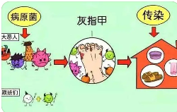 实力精选!上海治灰指甲医院排行 灰指甲上海哪个医院好