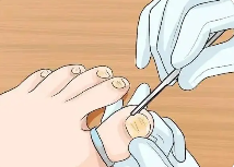 上海甲沟炎去哪家医院看-手指甲沟炎的简单处理方法