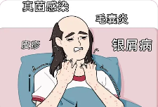 上海毛囊炎医院哪个比较好-头皮上长了毛囊炎疙瘩怎么治疗