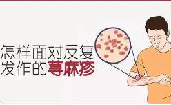 上海哪家荨麻疹医院看得好-荨麻疹治疗的好方法