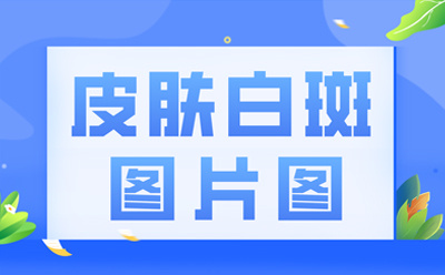 近期兰州本地患者咨询：白斑怎么治