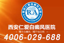榜单盘点：西安“专业”白癜风医院榜上有名-白癜风对人的心里影响有多大？
