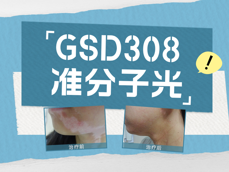 今日公开：北京专治白癜风医院“总榜公示”GSD308准分子光治疗面部白癜风